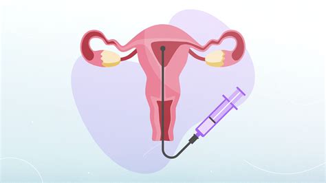 Intrauterine Insemination
